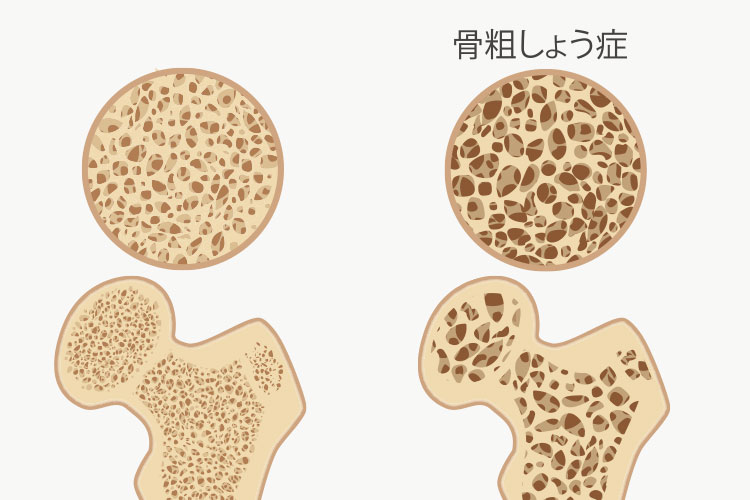 骨粗鬆症イメージ画像